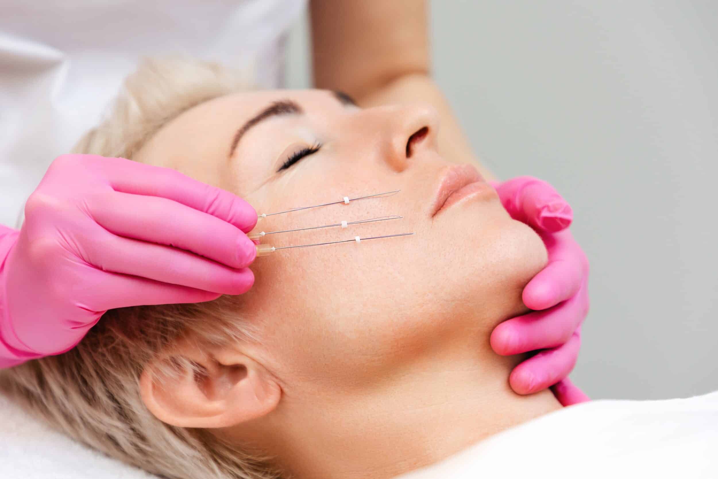 A professional cosmetologist wearing pink gloves holds thread lifting needles near the cheek of an adult woman during a non-surgical facelift procedure