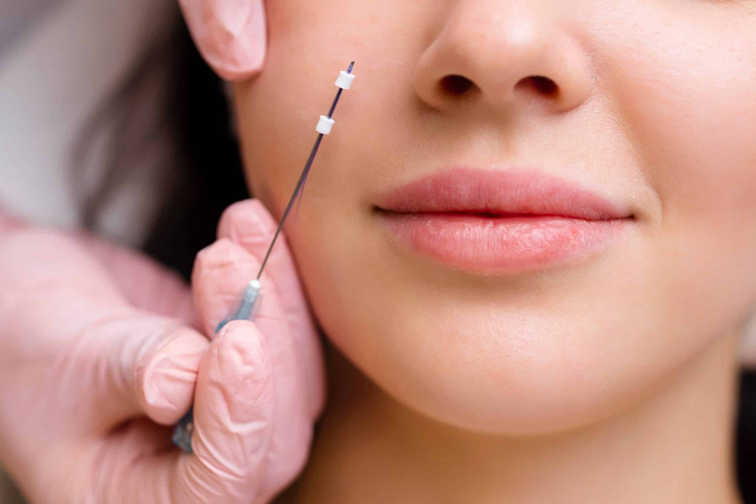 A cosmetologist prepares for a PDO thread lift procedure, selecting the appropriate threads to perform a non-surgical face lifting treatment on a female client