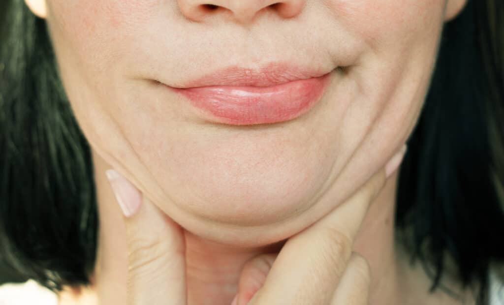 Woman with visible double chin looking for contouring improvement, concept of Kybella treatment for submental fat reduction
