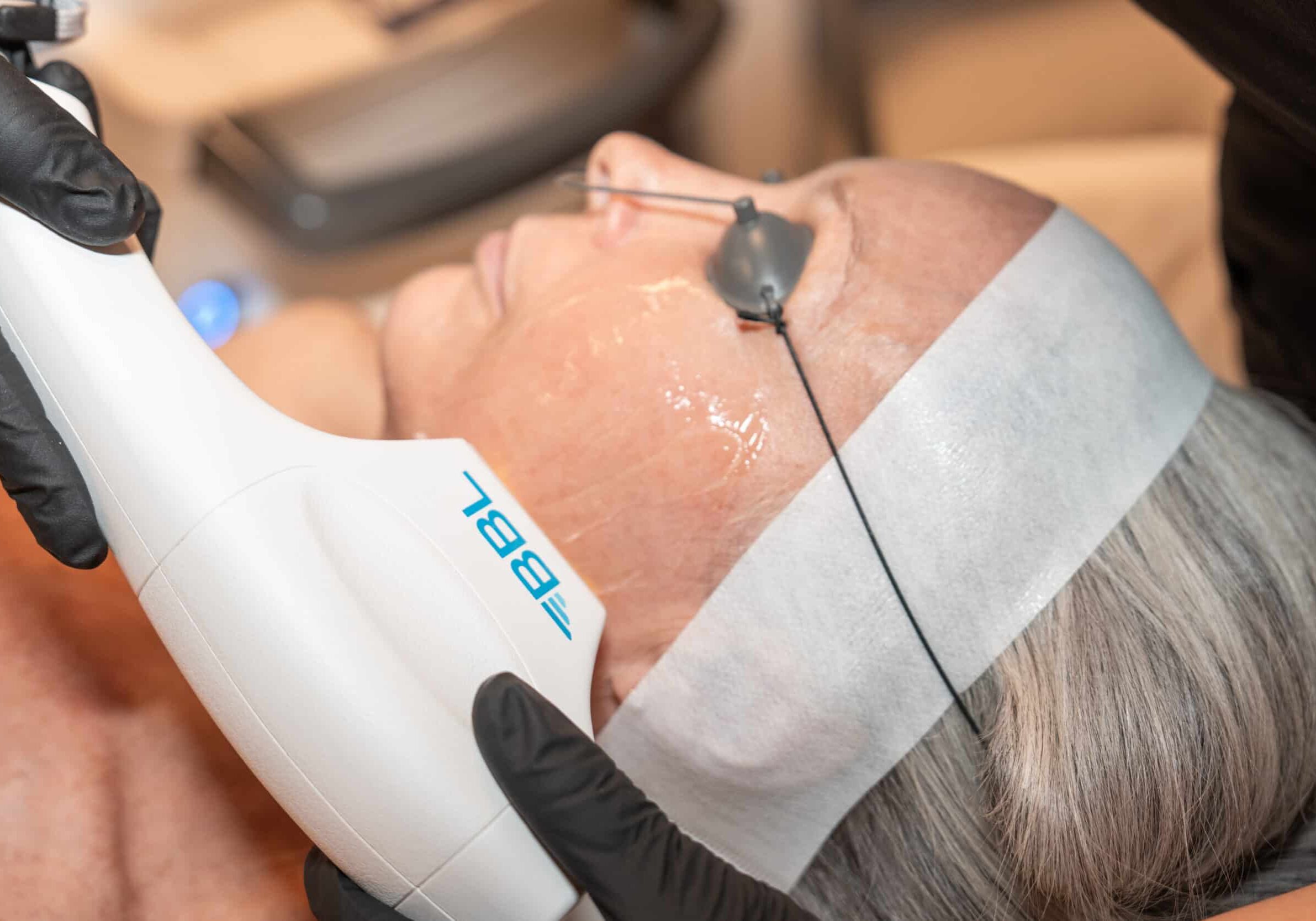 BBL HERO Laser Treatment Aspen CO